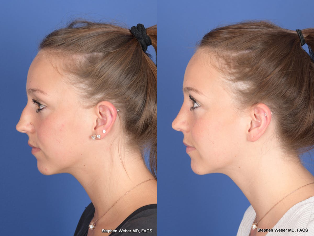 Rhinoplasty Before & After Gallery - Patient 126858 - Image 2