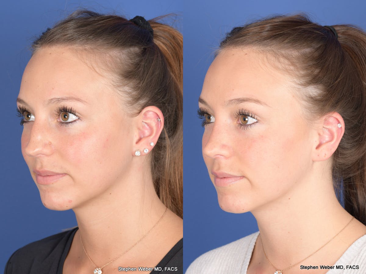 Rhinoplasty Before & After Gallery - Patient 126858 - Image 3