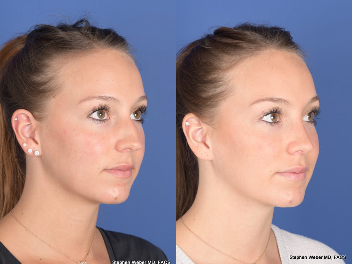 Rhinoplasty Before & After Gallery - Patient 126858 - Image 4