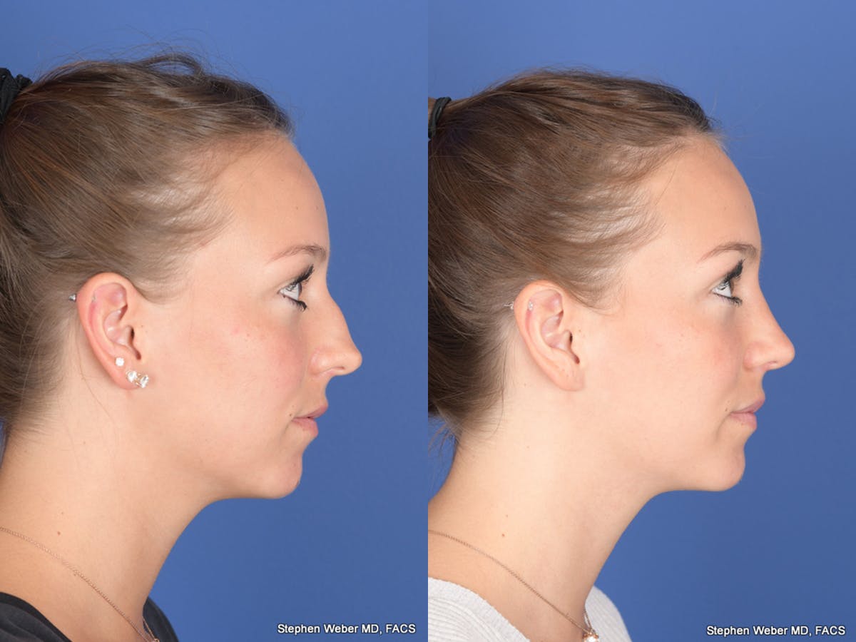 Rhinoplasty Before & After Gallery - Patient 126858 - Image 5