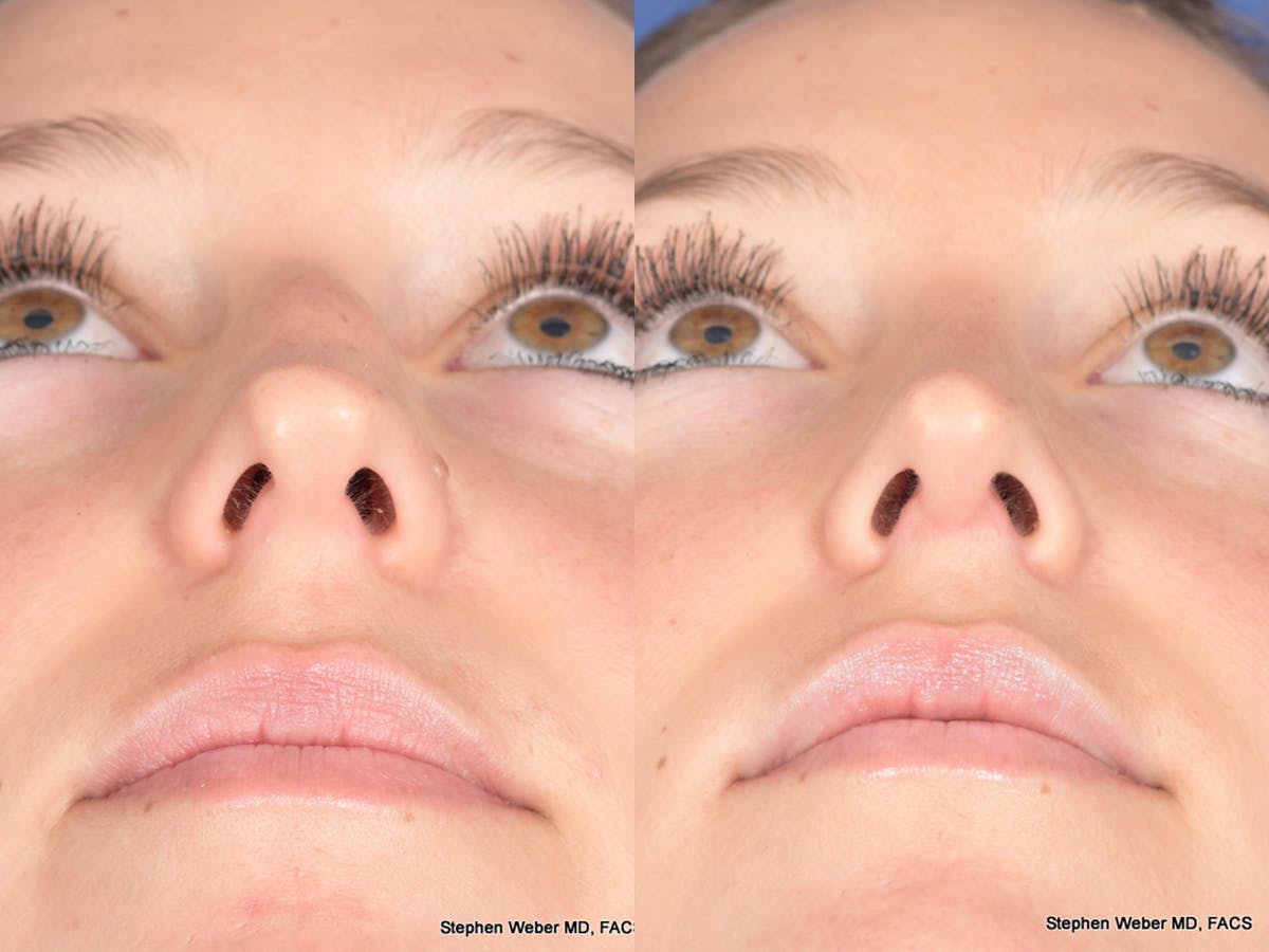 Rhinoplasty Before & After Gallery - Patient 126858 - Image 6