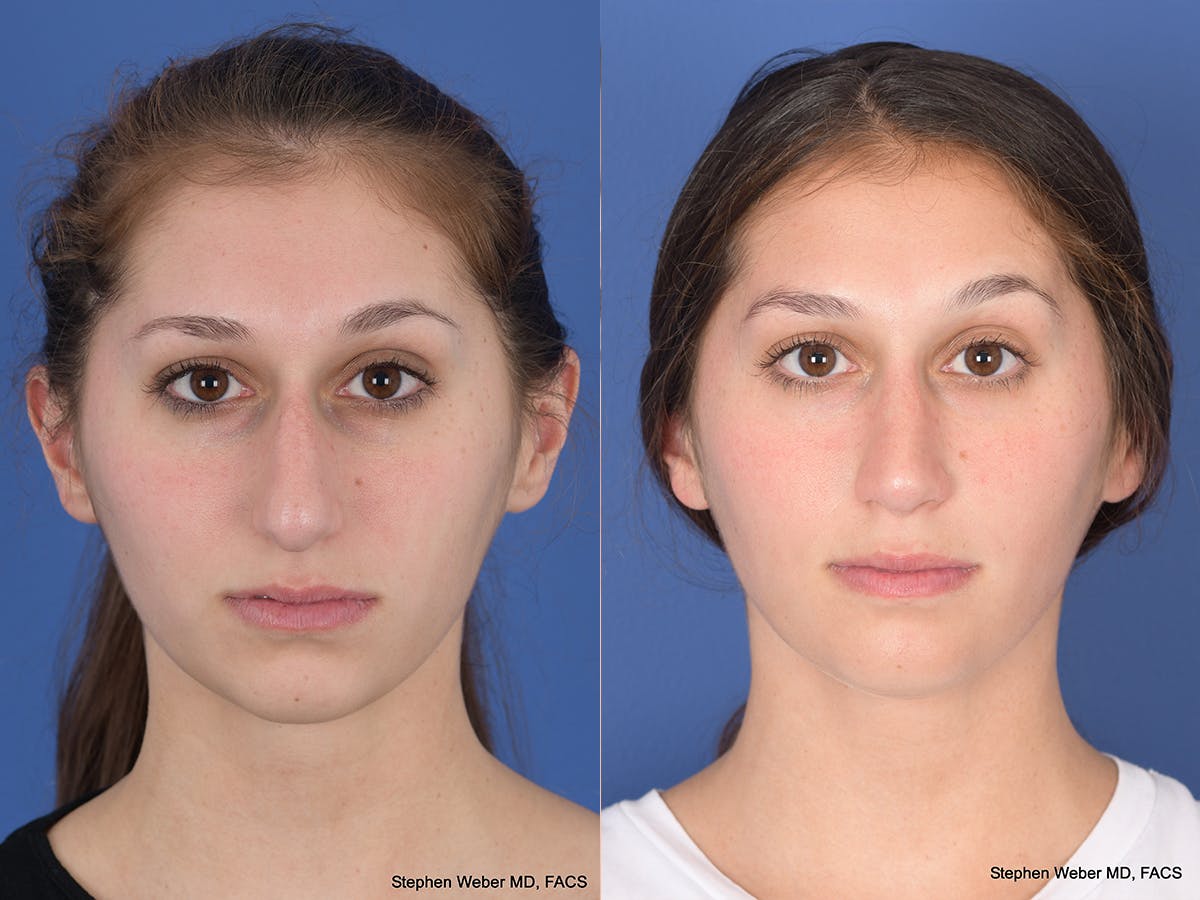 Rhinoplasty Before & After Gallery - Patient 111504 - Image 1