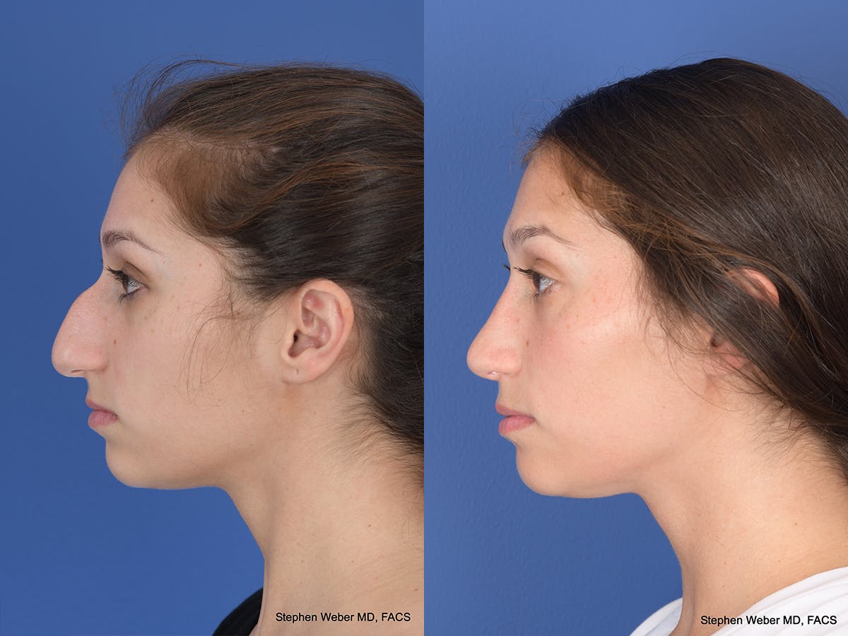 Rhinoplasty Before & After Gallery - Patient 111504 - Image 2