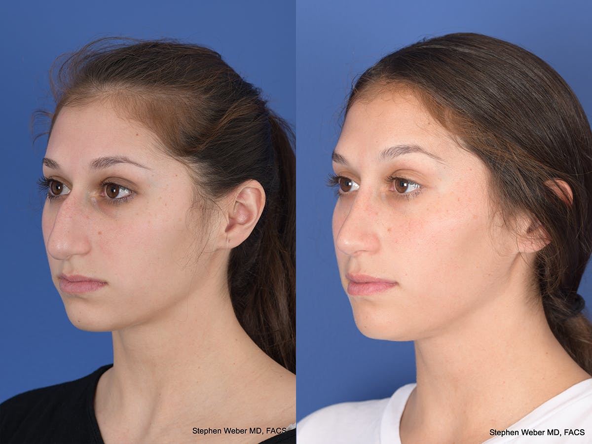 Rhinoplasty Before & After Gallery - Patient 111504 - Image 3