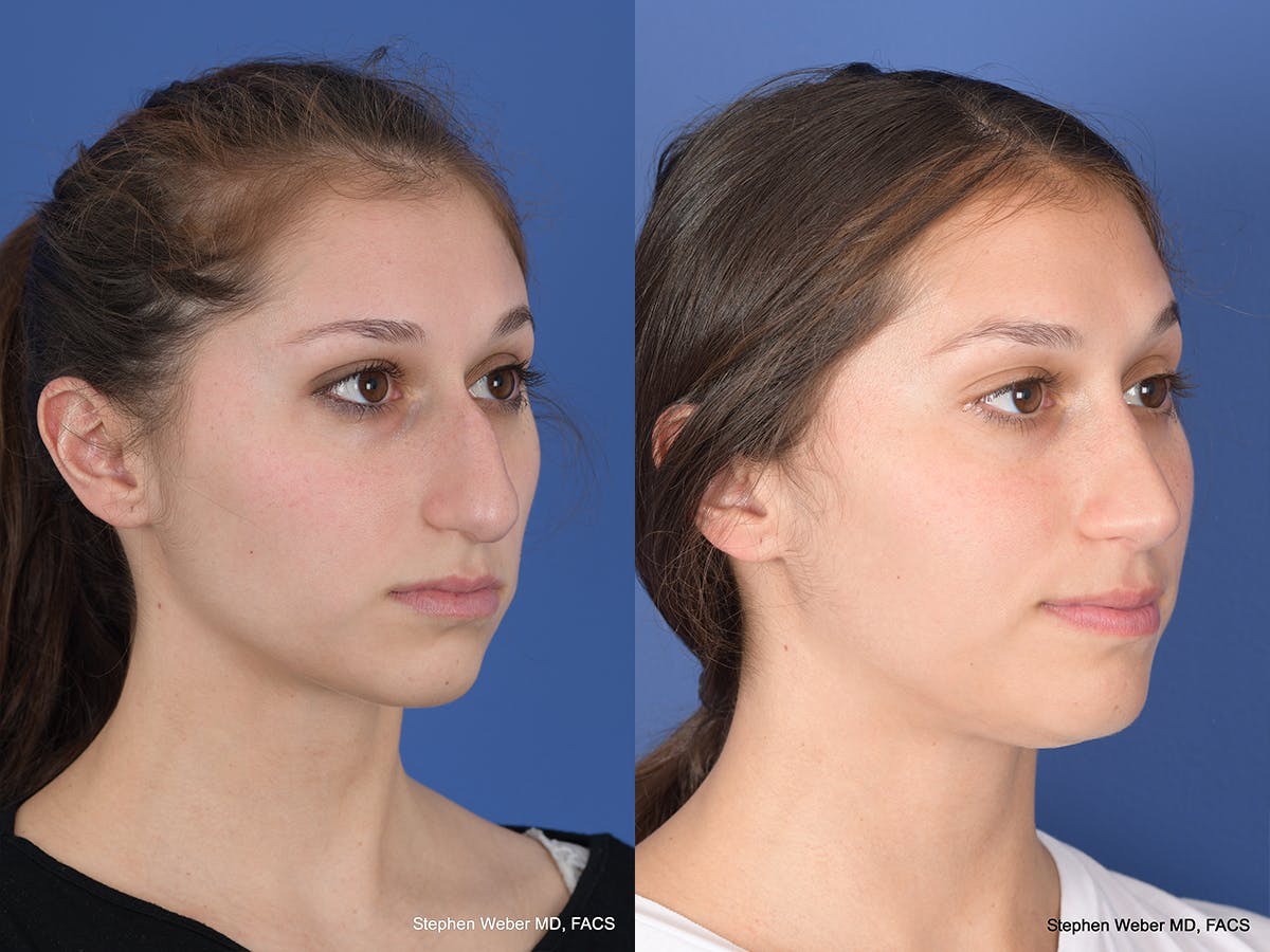Rhinoplasty Before & After Gallery - Patient 111504 - Image 4