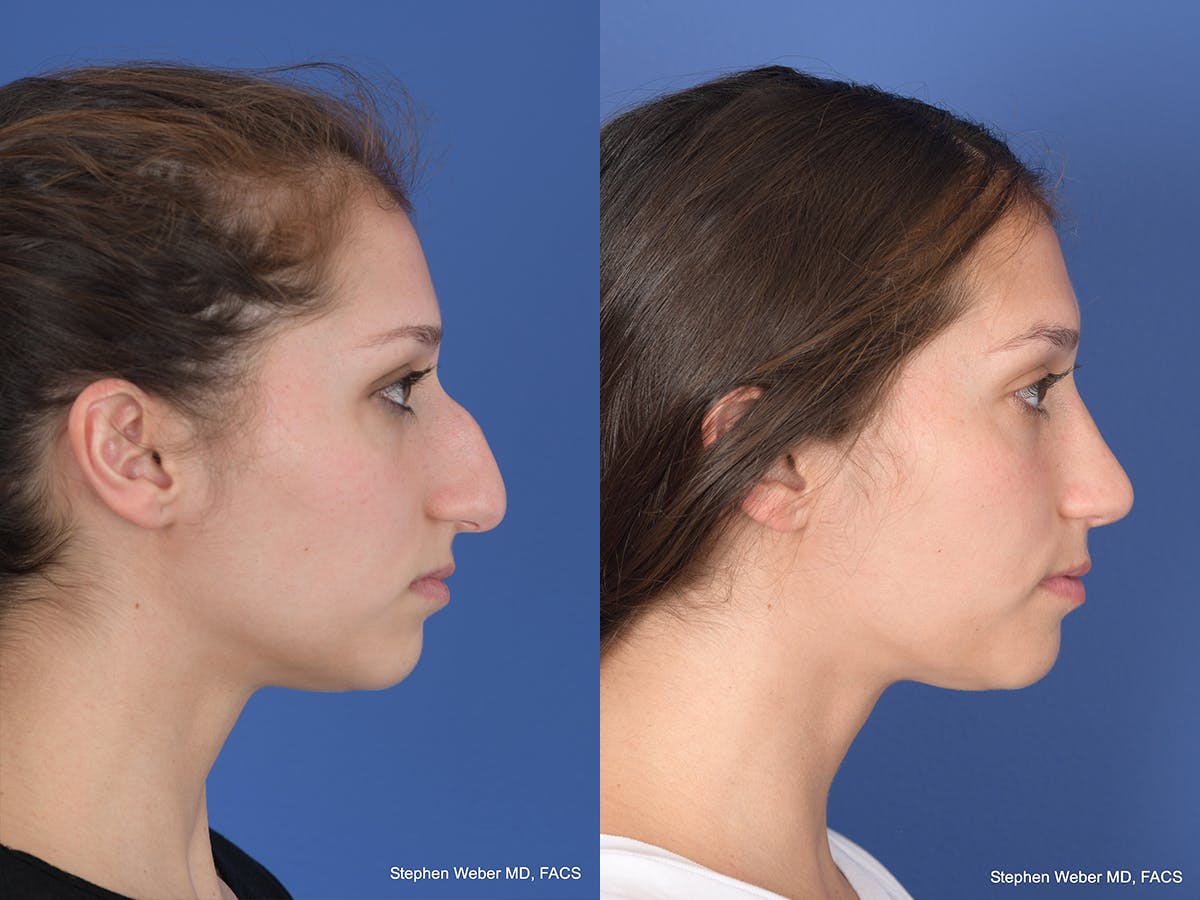 Rhinoplasty Before & After Gallery - Patient 111504 - Image 5