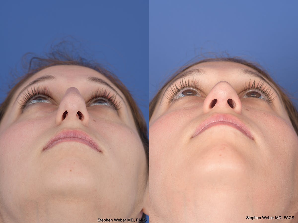 Rhinoplasty Before & After Gallery - Patient 111504 - Image 6