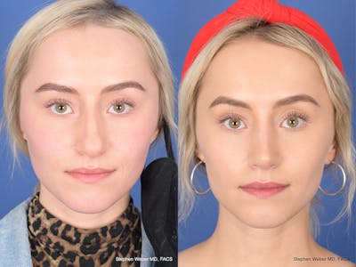Rhinoplasty Before & After Gallery - Patient 290843 - Image 1