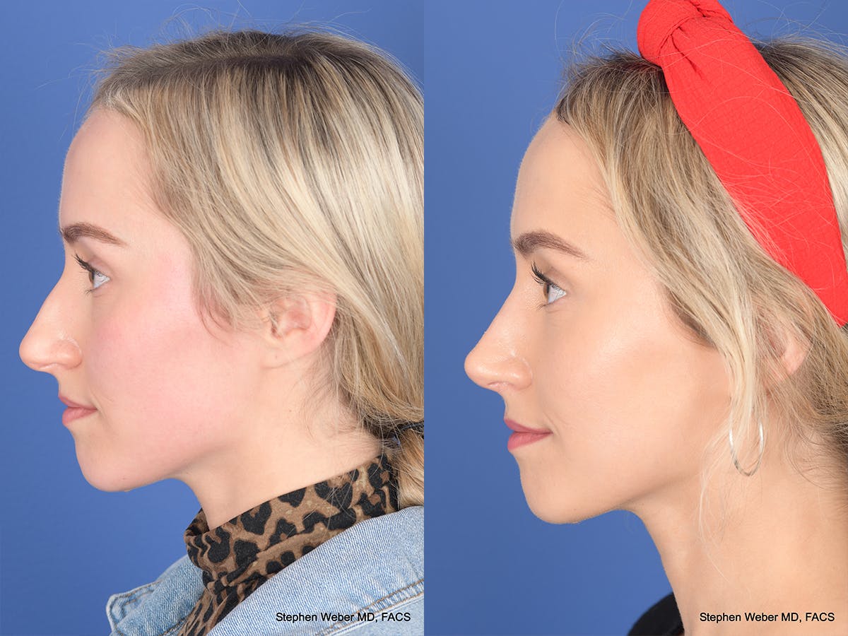 Rhinoplasty Before & After Gallery - Patient 290843 - Image 2