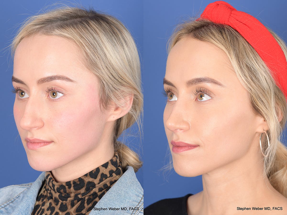 Rhinoplasty Before & After Gallery - Patient 290843 - Image 3