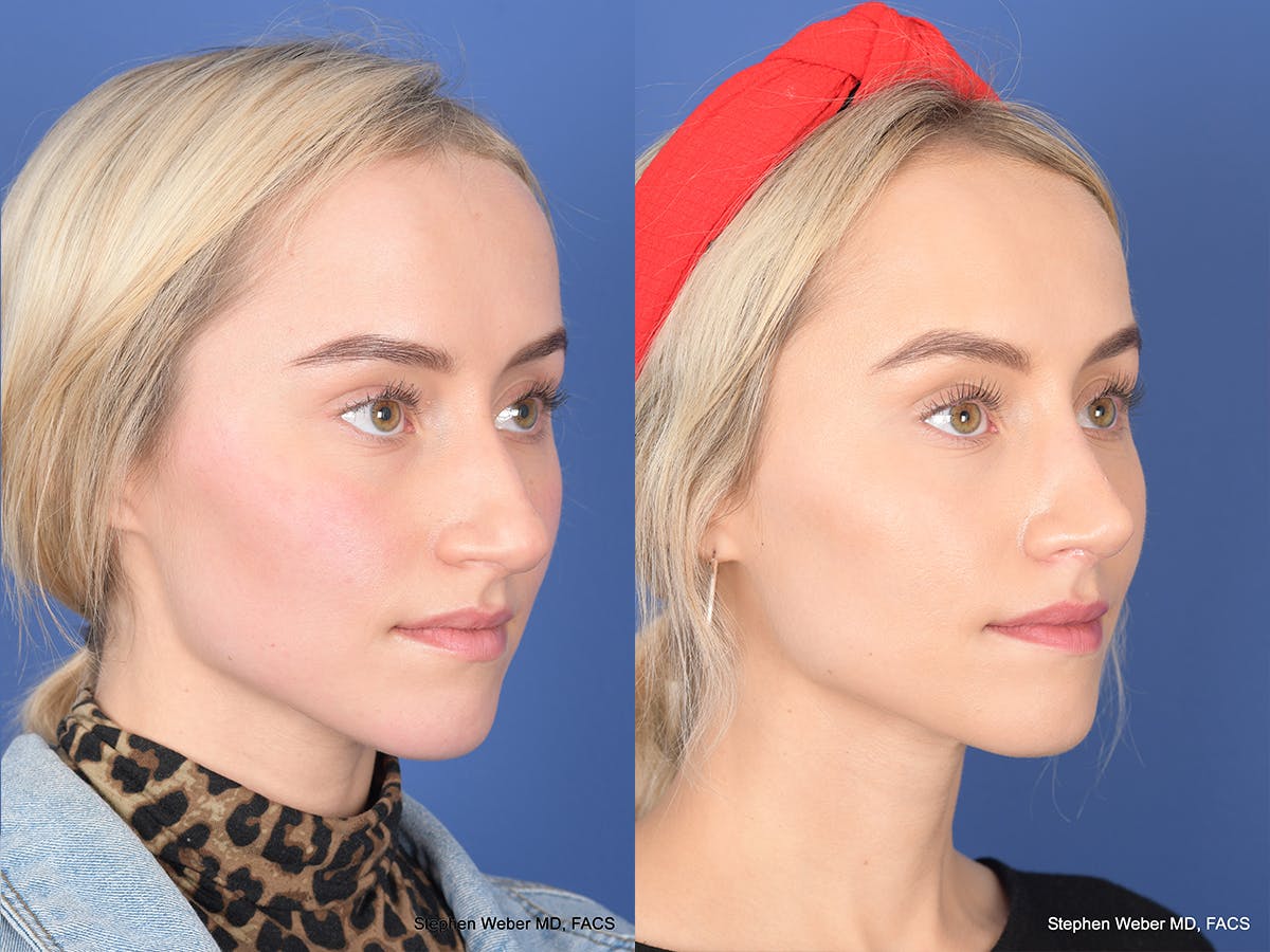 Rhinoplasty Before & After Gallery - Patient 290843 - Image 4