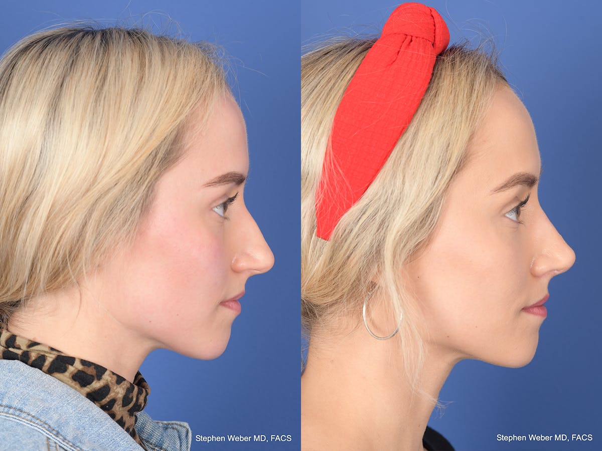 Rhinoplasty Before & After Gallery - Patient 290843 - Image 5