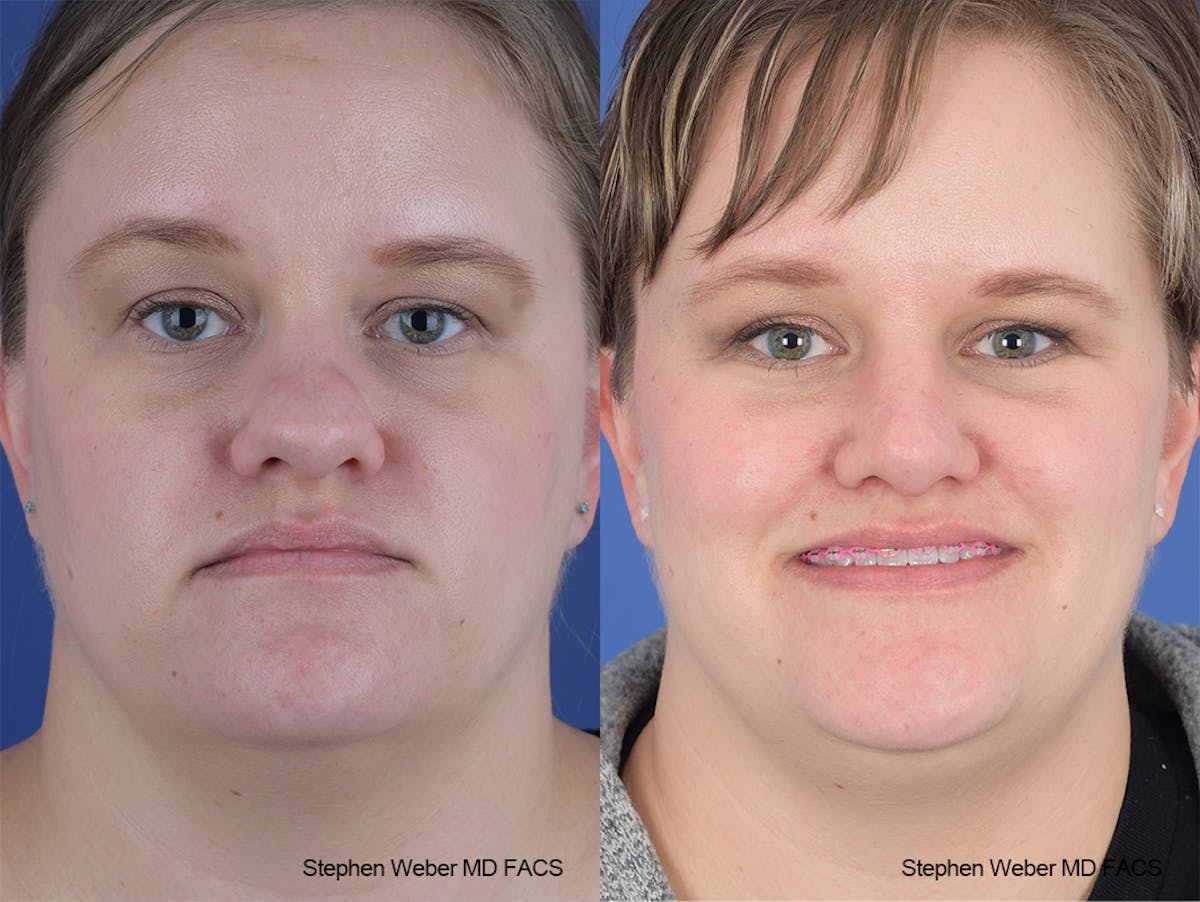 Rhinoplasty Before & After Gallery - Patient 651354 - Image 1