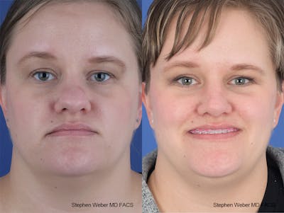 Rhinoplasty Before & After Gallery - Patient 651354 - Image 1