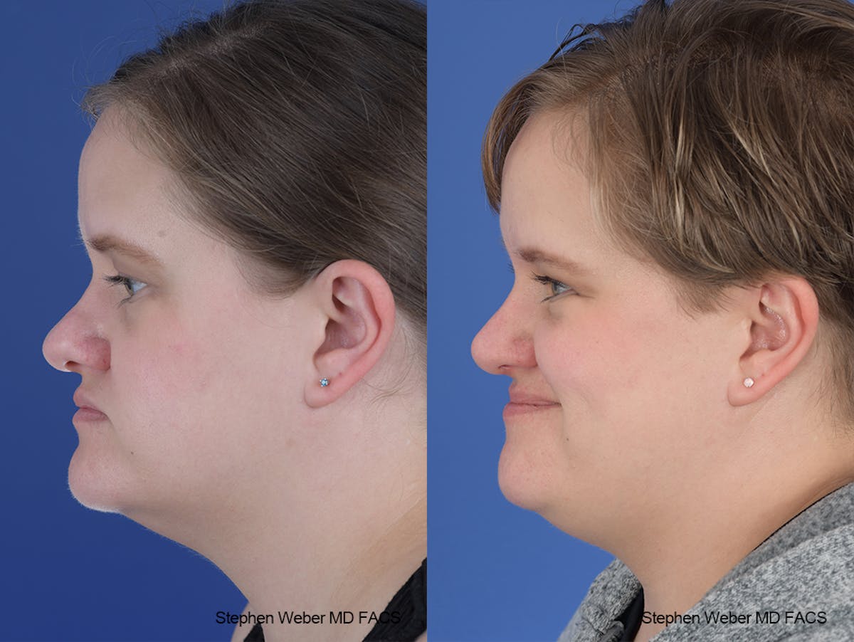 Rhinoplasty Before & After Gallery - Patient 651354 - Image 2