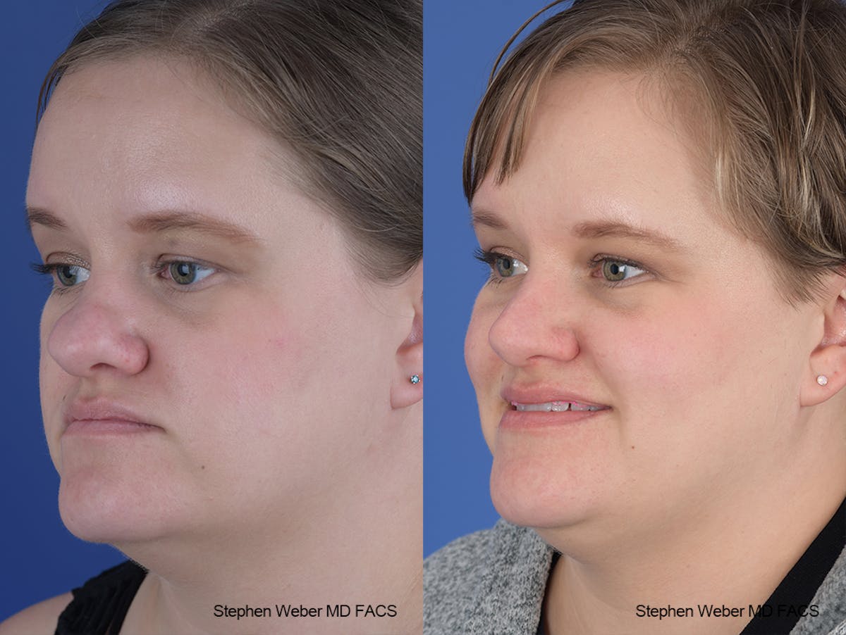 Rhinoplasty Before & After Gallery - Patient 651354 - Image 3