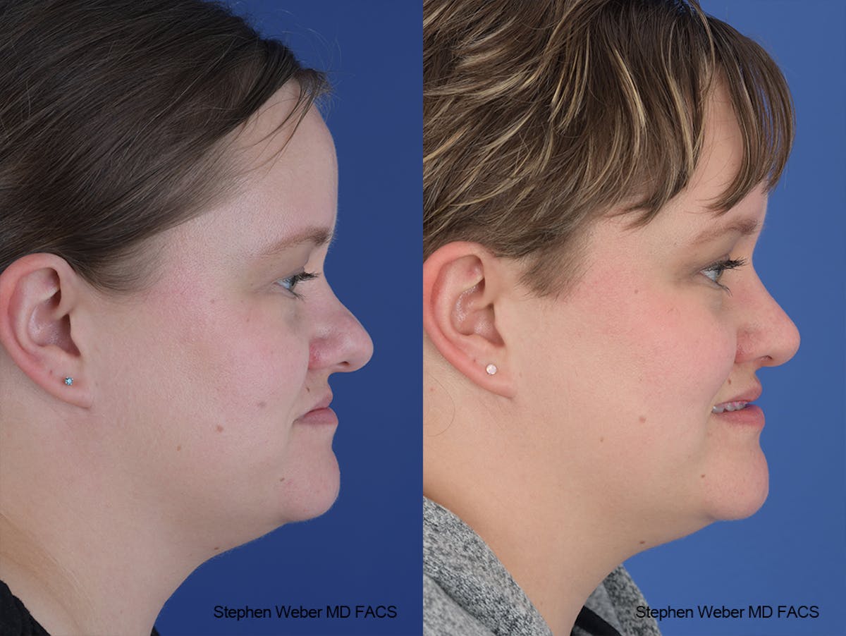 Rhinoplasty Before & After Gallery - Patient 651354 - Image 4