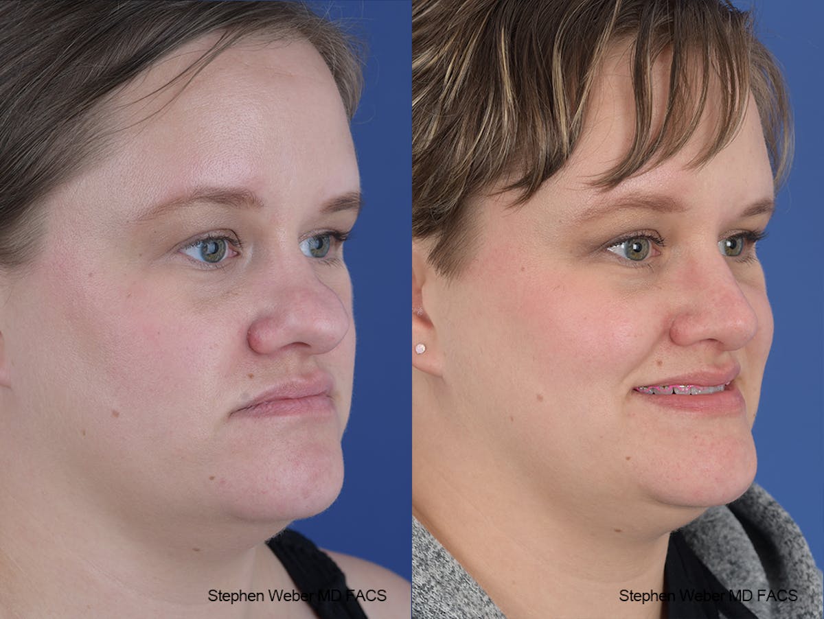 Rhinoplasty Before & After Gallery - Patient 651354 - Image 5