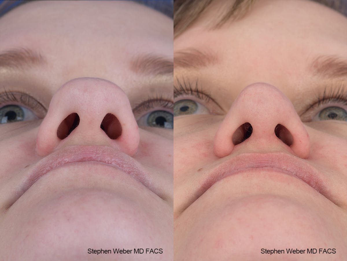 Rhinoplasty Before & After Gallery - Patient 651354 - Image 6