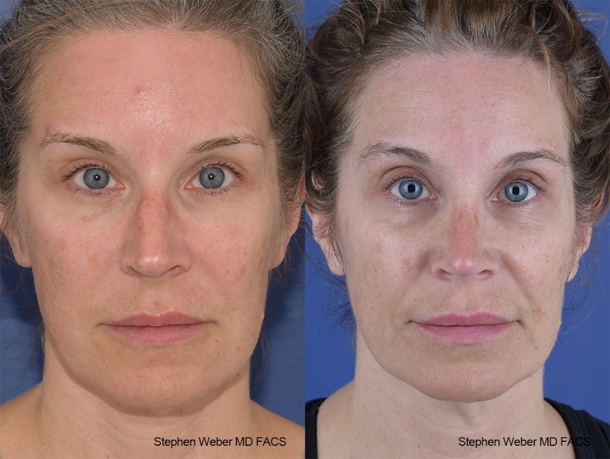 Rhinoplasty Before & After Gallery - Patient 244712 - Image 1