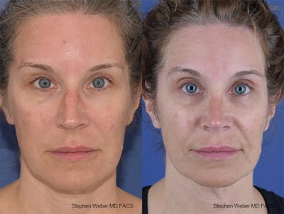 Rhinoplasty Before & After Gallery - Patient 244712 - Image 1