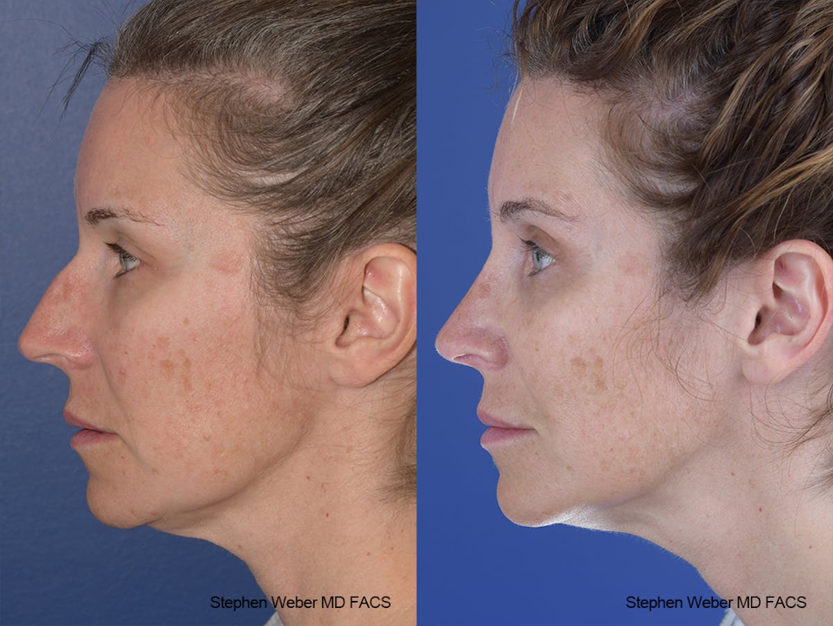 Rhinoplasty Before & After Gallery - Patient 244712 - Image 2