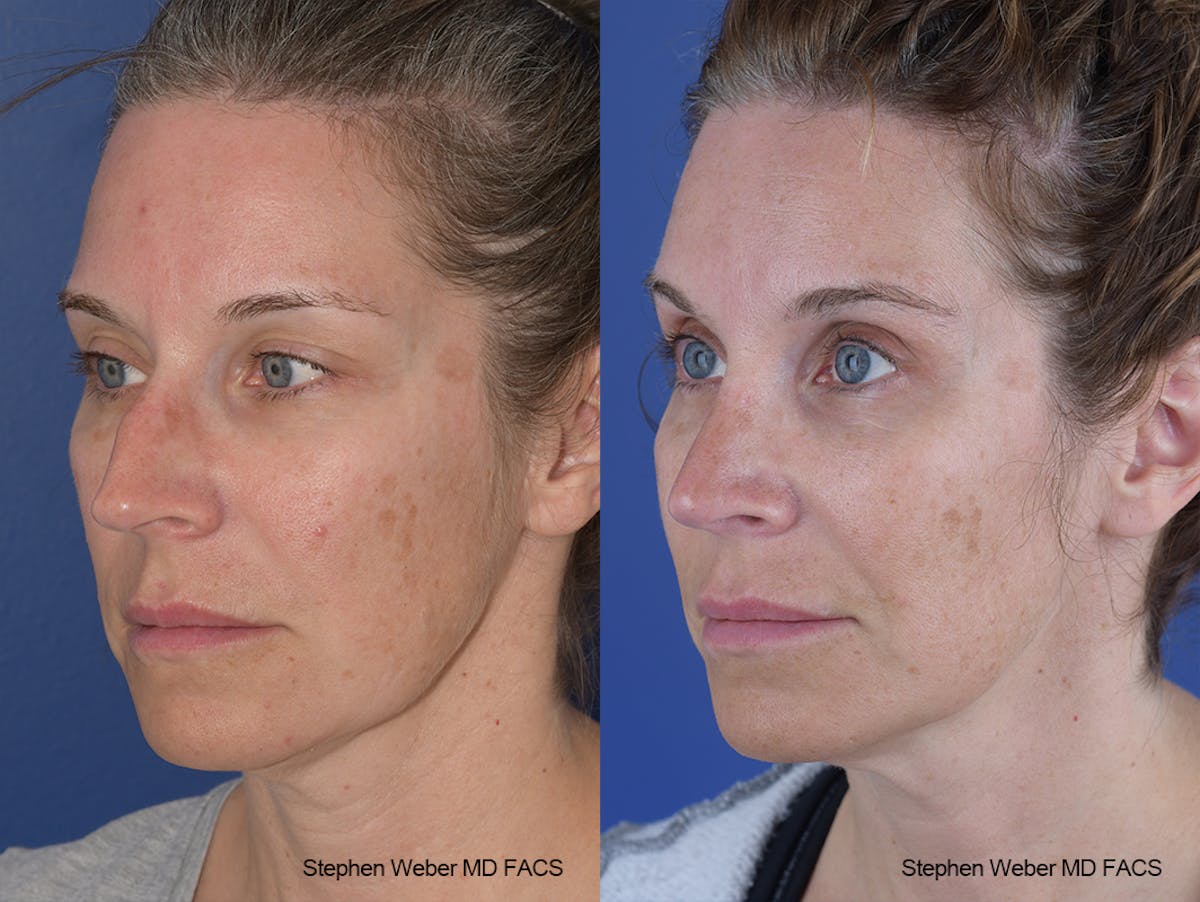 Rhinoplasty Before & After Gallery - Patient 244712 - Image 3