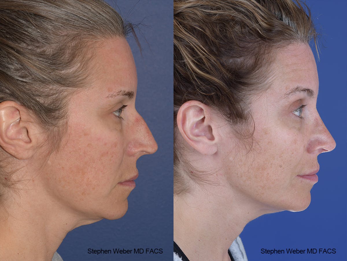 Rhinoplasty Before & After Gallery - Patient 244712 - Image 4