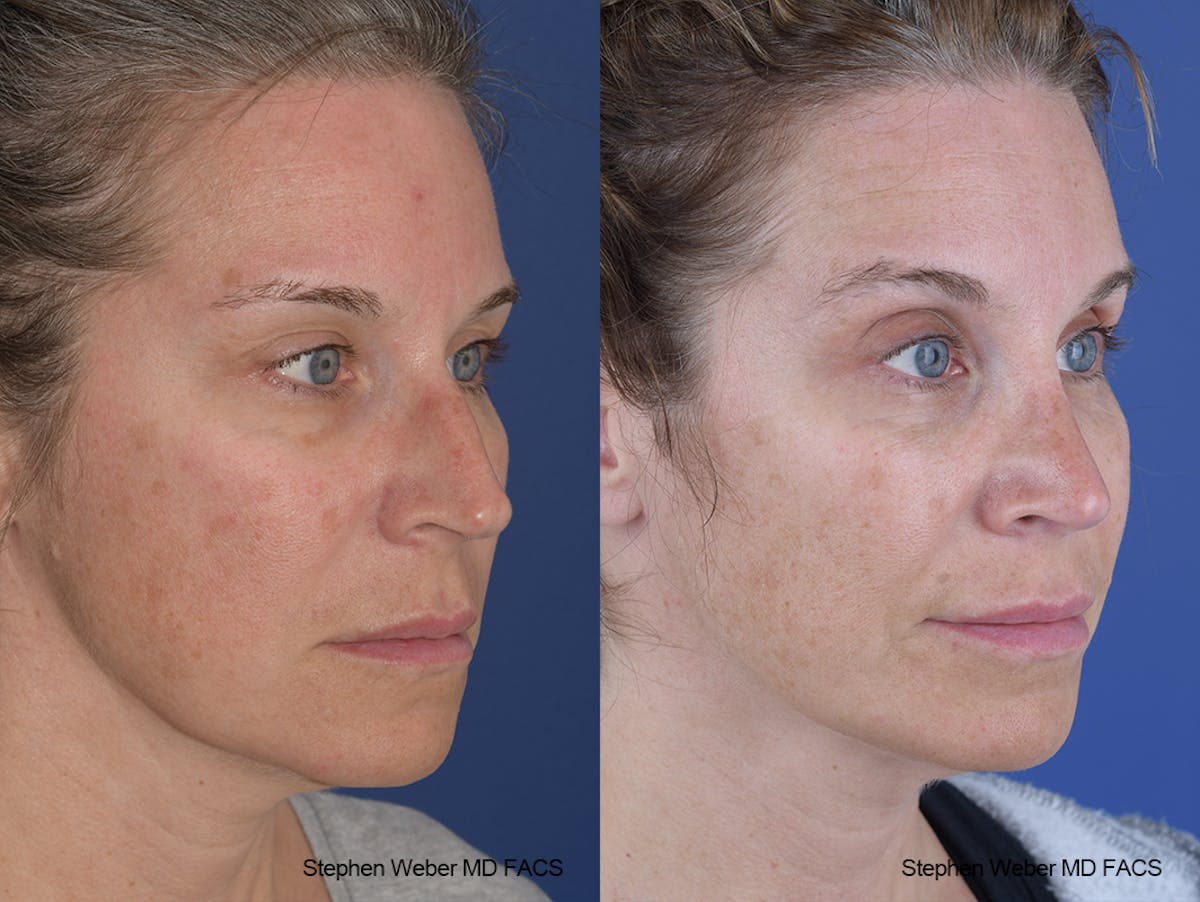 Rhinoplasty Before & After Gallery - Patient 244712 - Image 5