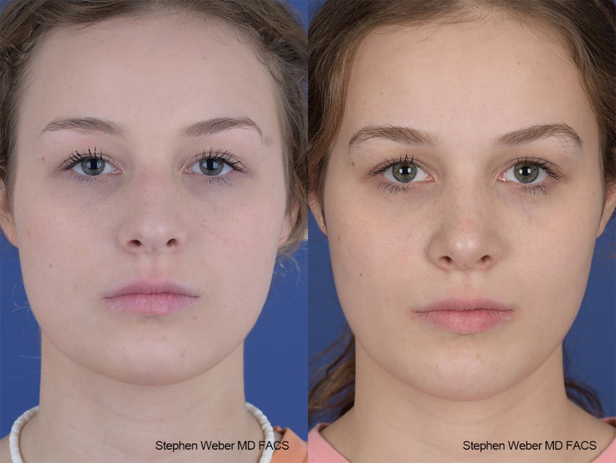 Rhinoplasty Before & After Gallery - Patient 284770 - Image 1