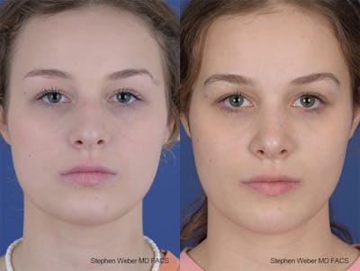 Rhinoplasty Before & After Gallery - Patient 284770 - Image 1