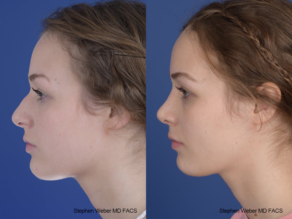 Rhinoplasty Before & After Gallery - Patient 284770 - Image 2