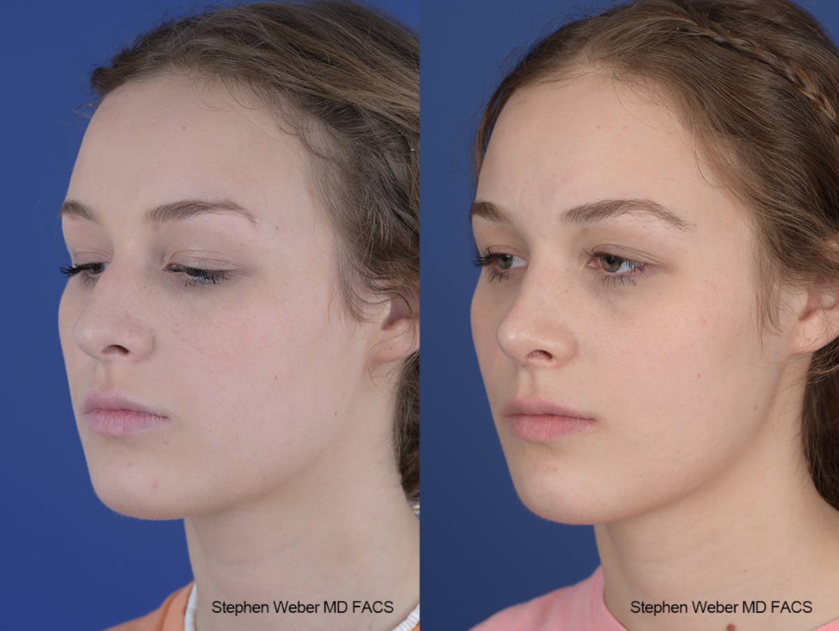 Rhinoplasty Before & After Gallery - Patient 284770 - Image 3