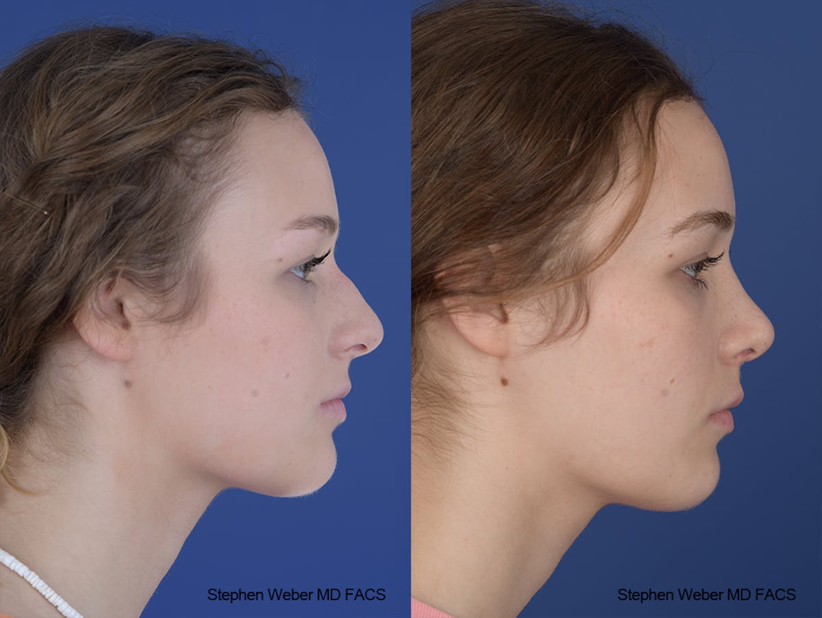 Rhinoplasty Before & After Gallery - Patient 284770 - Image 4