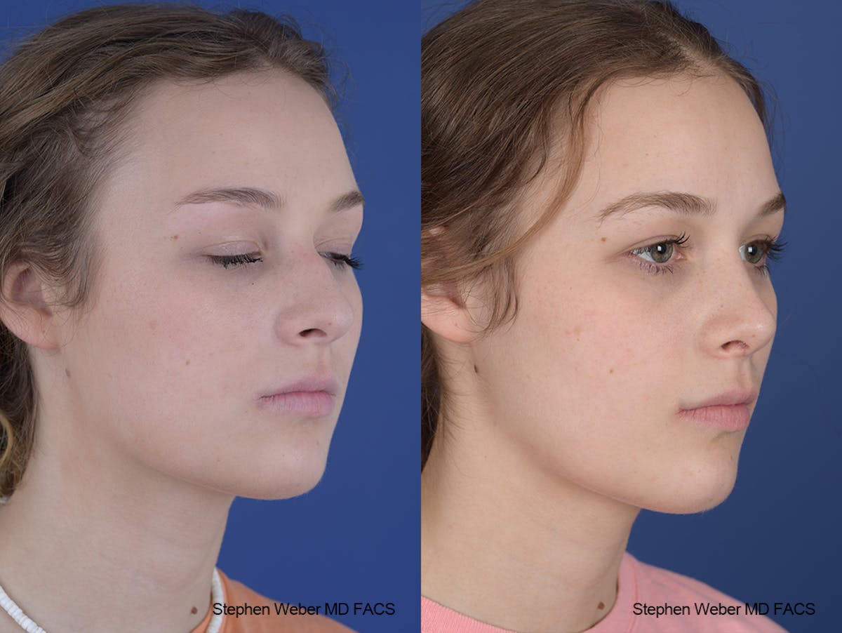 Rhinoplasty Before & After Gallery - Patient 284770 - Image 5