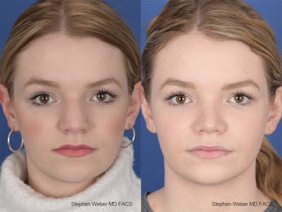 Rhinoplasty Before & After Gallery - Patient 357511 - Image 1