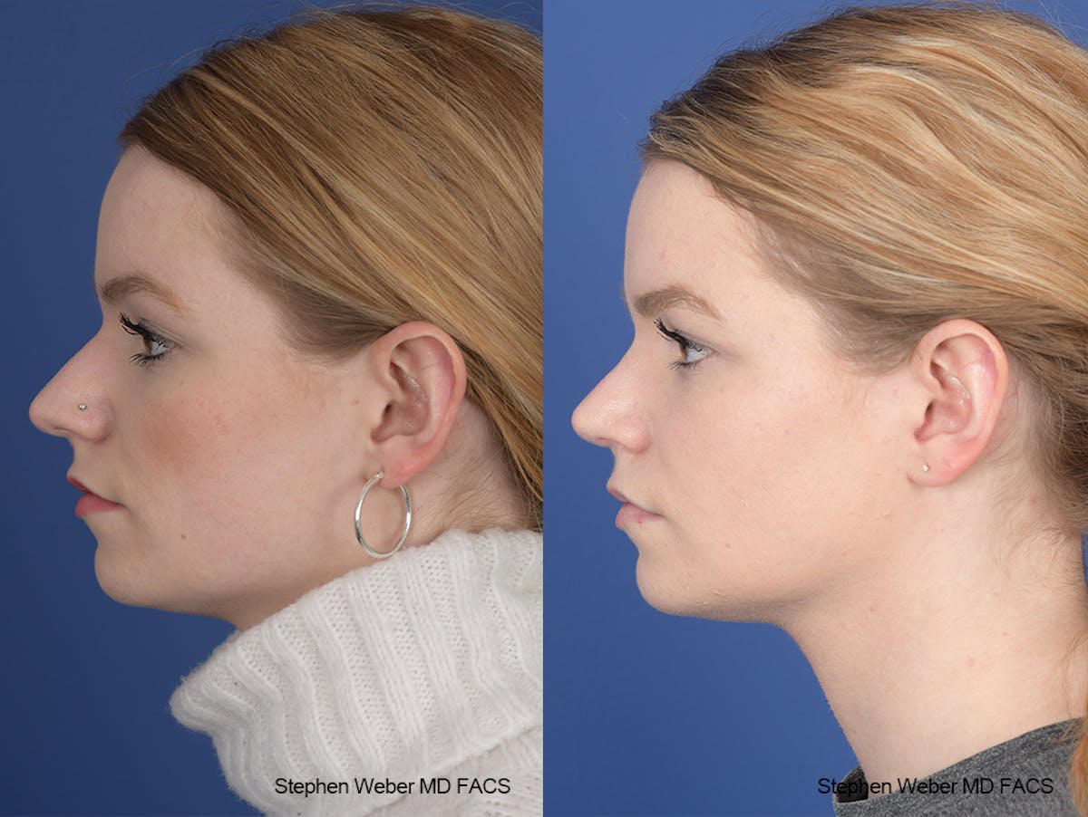 Rhinoplasty Before & After Gallery - Patient 357511 - Image 2