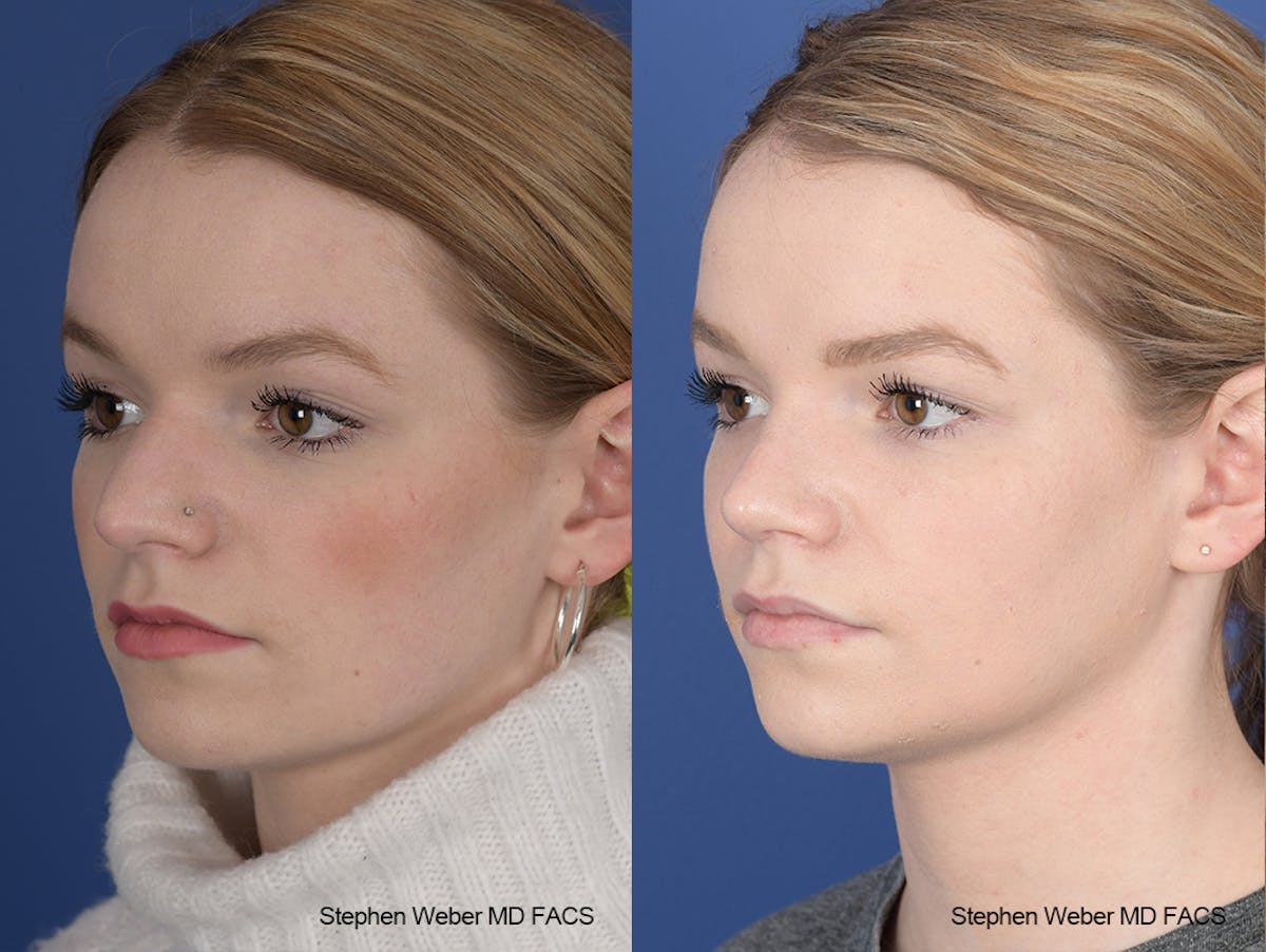 Rhinoplasty Before & After Gallery - Patient 357511 - Image 3