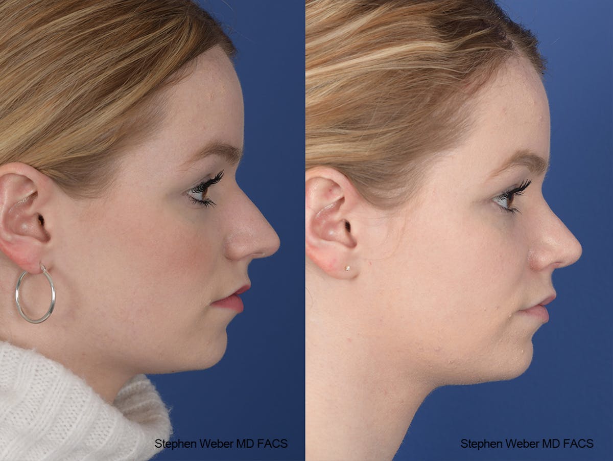 Rhinoplasty Before & After Gallery - Patient 357511 - Image 4