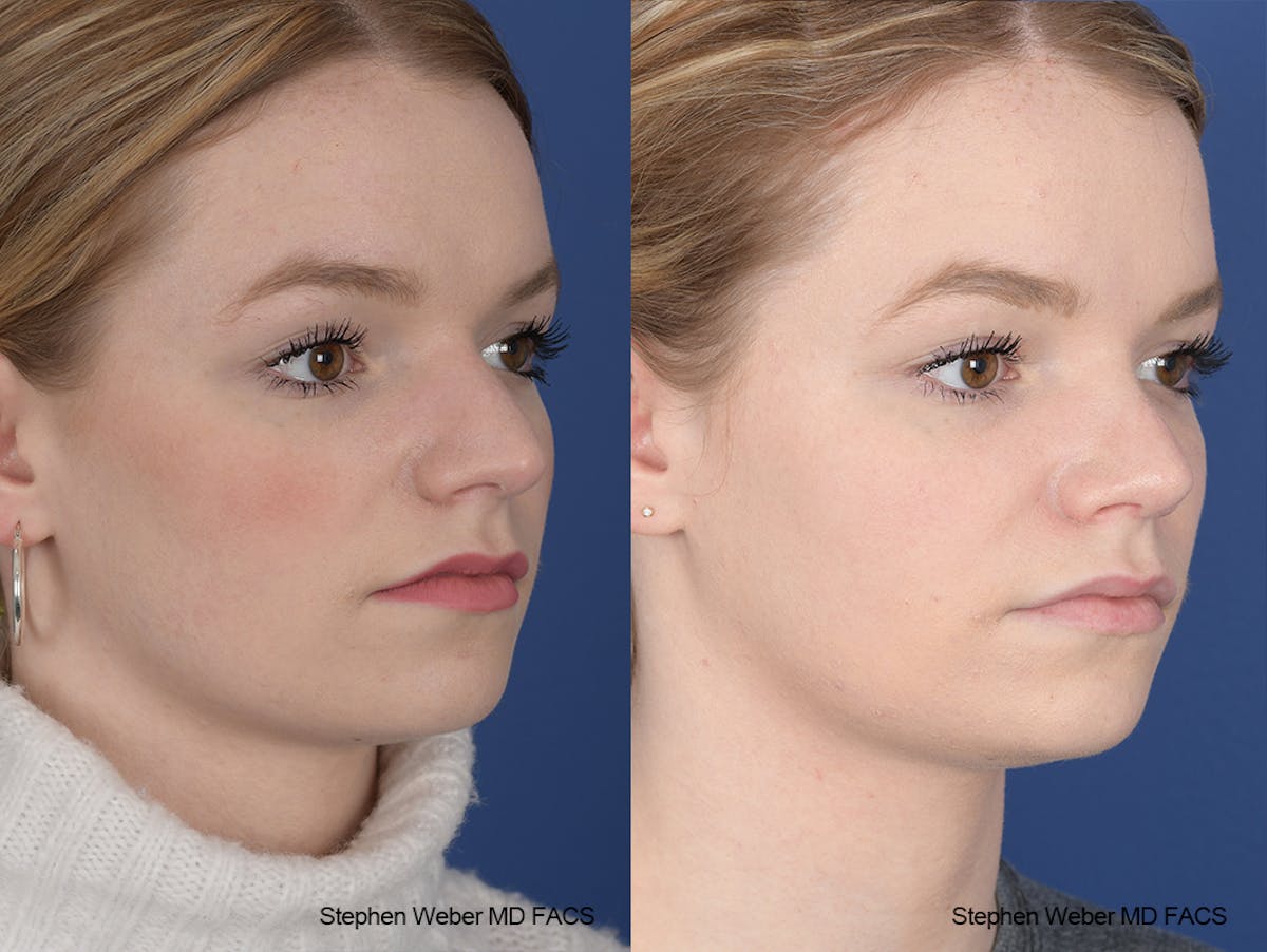 Rhinoplasty Before & After Gallery - Patient 357511 - Image 5