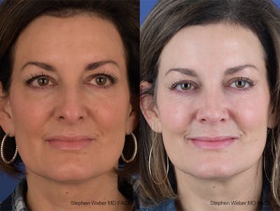 Rhinoplasty Before & After Gallery - Patient 915607 - Image 1