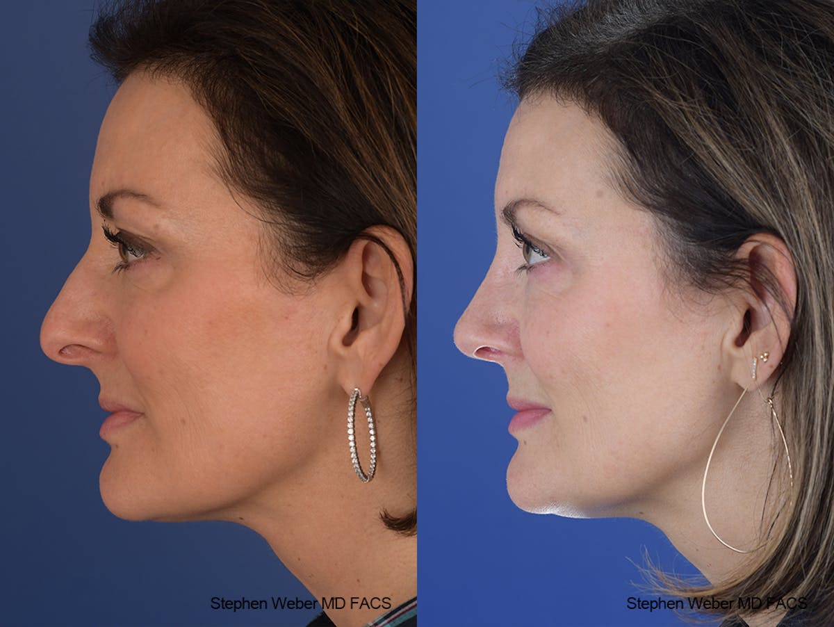 Rhinoplasty Before & After Gallery - Patient 915607 - Image 2