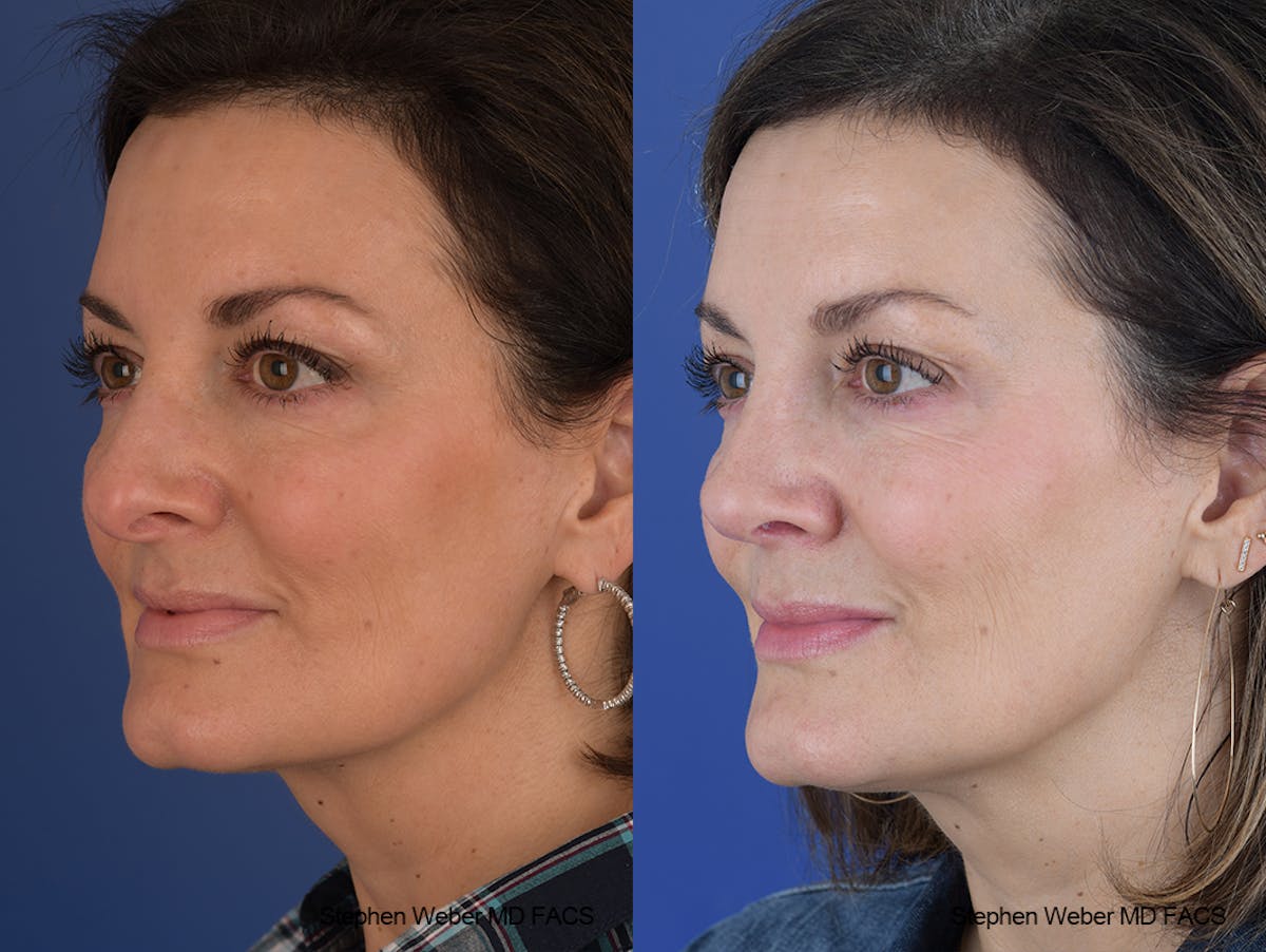 Rhinoplasty Before & After Gallery - Patient 915607 - Image 3