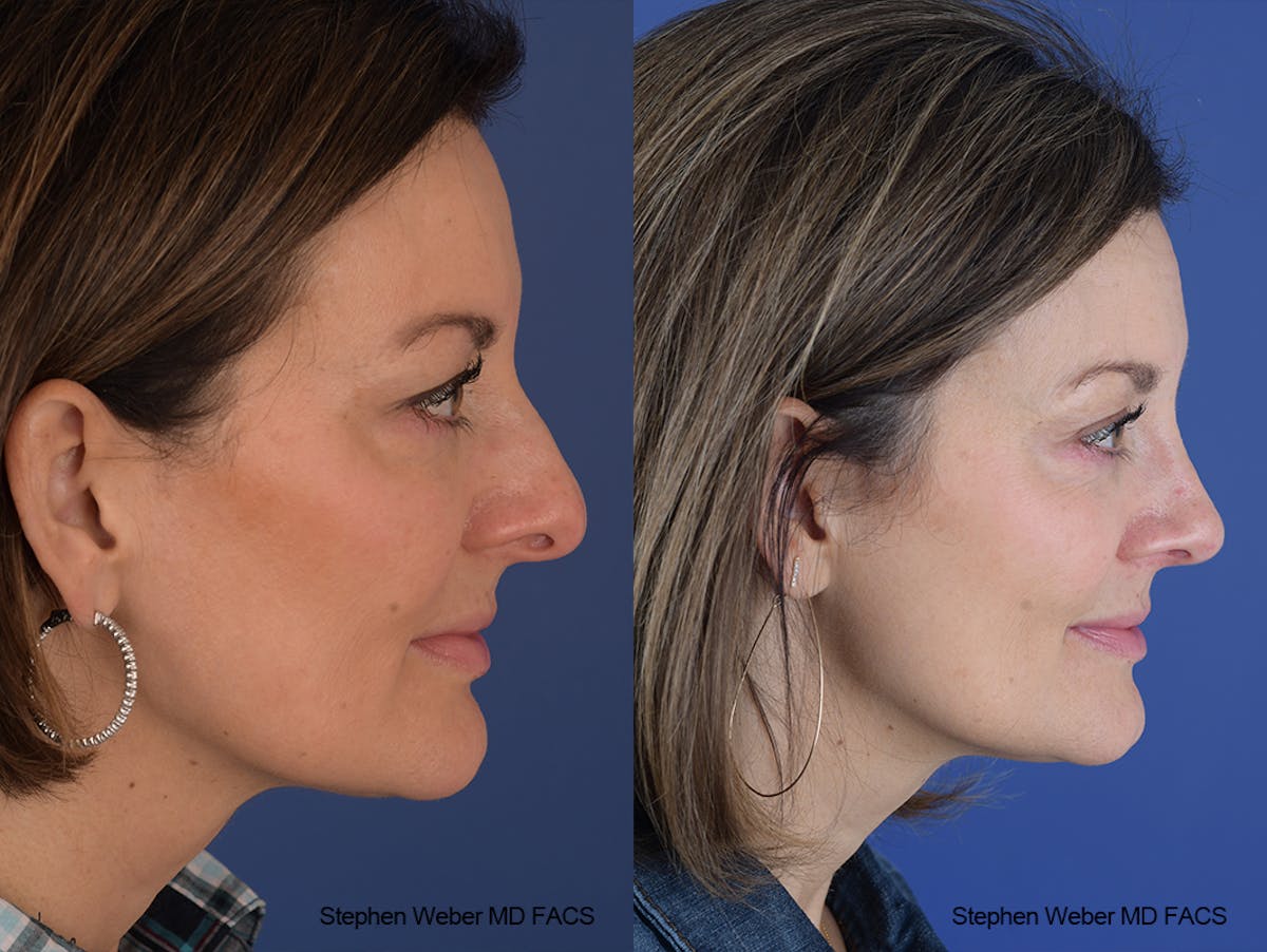Rhinoplasty Before & After Gallery - Patient 915607 - Image 4