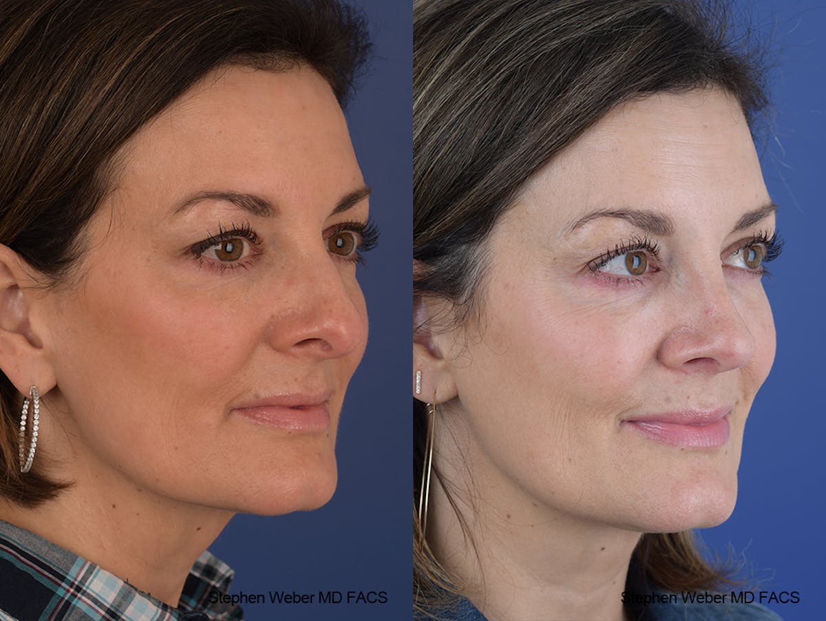 Rhinoplasty Before & After Gallery - Patient 915607 - Image 5