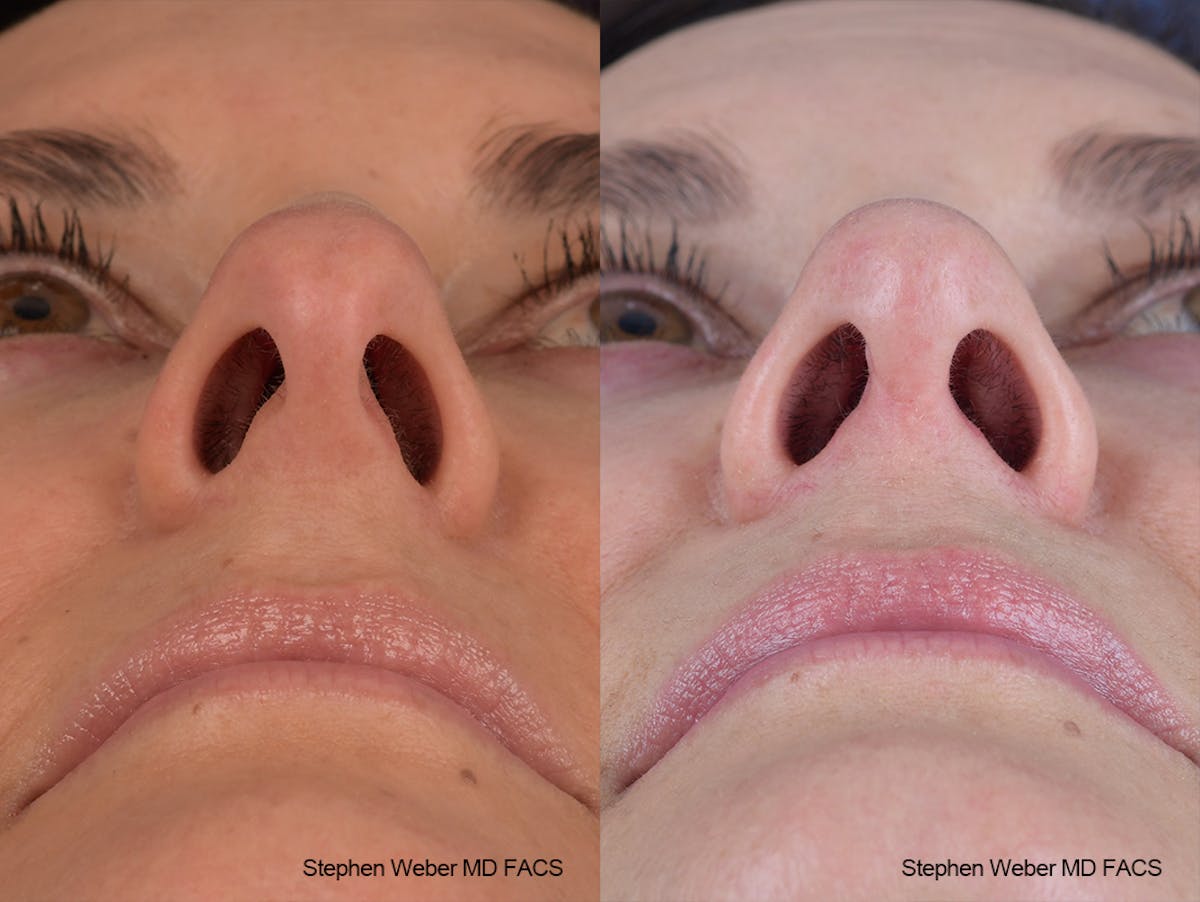 Rhinoplasty Before & After Gallery - Patient 915607 - Image 6