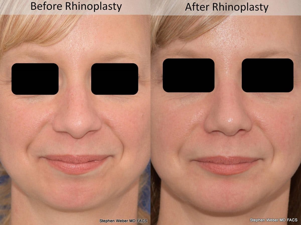 Rhinoplasty Before & After Gallery - Patient 387186 - Image 1