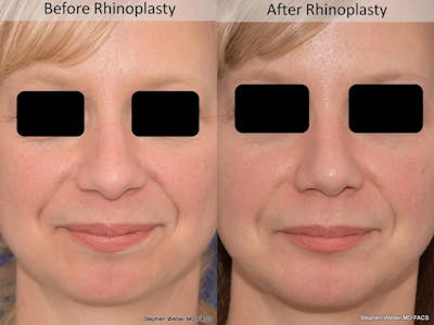 Rhinoplasty Before & After Gallery - Patient 387186 - Image 1