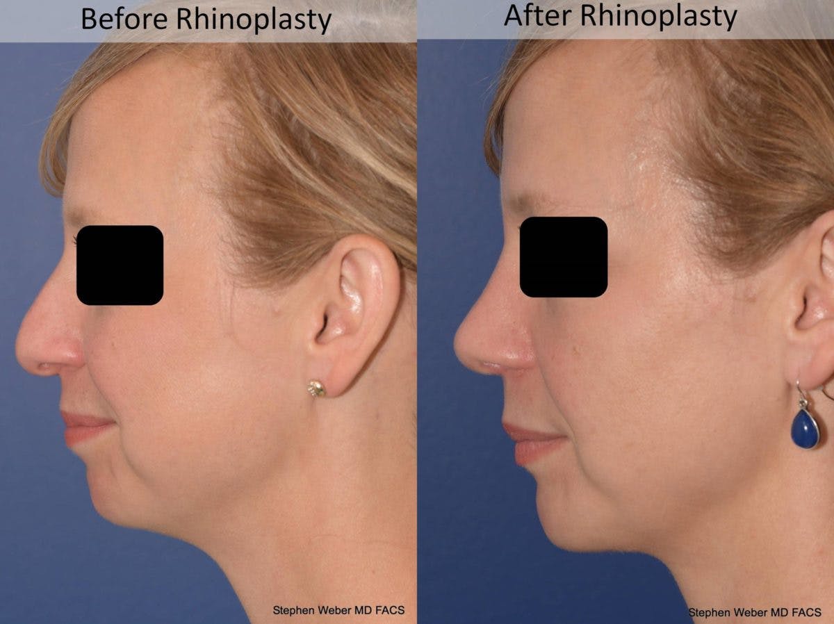Rhinoplasty Before & After Gallery - Patient 387186 - Image 2