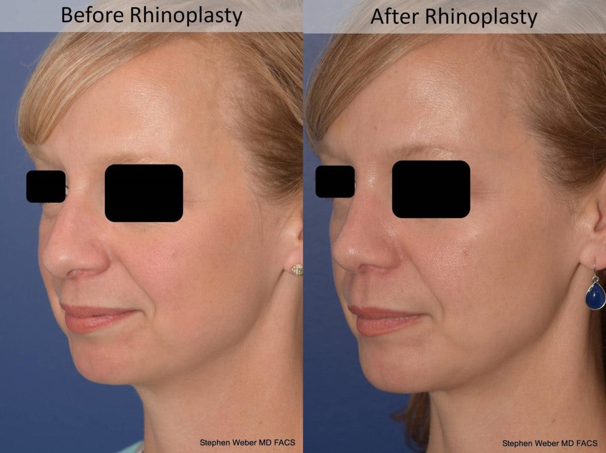 Rhinoplasty Before & After Gallery - Patient 387186 - Image 3